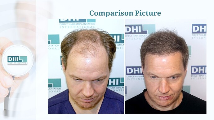 DHI India™ | NW 6 | 2,507 Grafts | 4 Months Hair Transplant Results photo