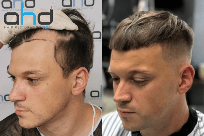 AHD Clinic / Technicians / 2250 grafts / FUE + DHI photo