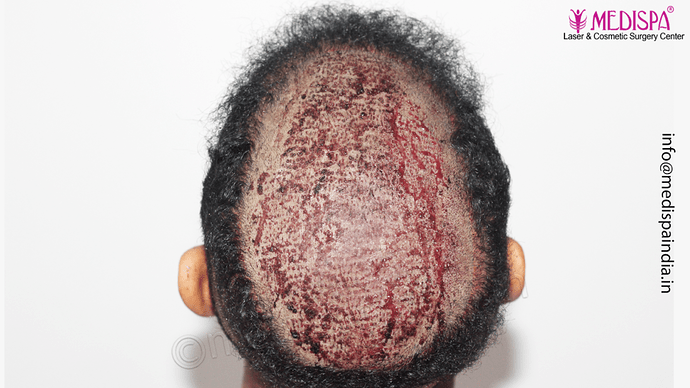 Dr. Suneet Soni - Afro Hair Transplant, 2 Sessions, 8355 Grafts, Combined FUT + FUE Technique, NW-VI, 5 Years Result photo