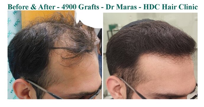 Result of 4900 Grafts on NW5 Patient – 8 Months After – Dr Maras – HDC Hair Clinic photo