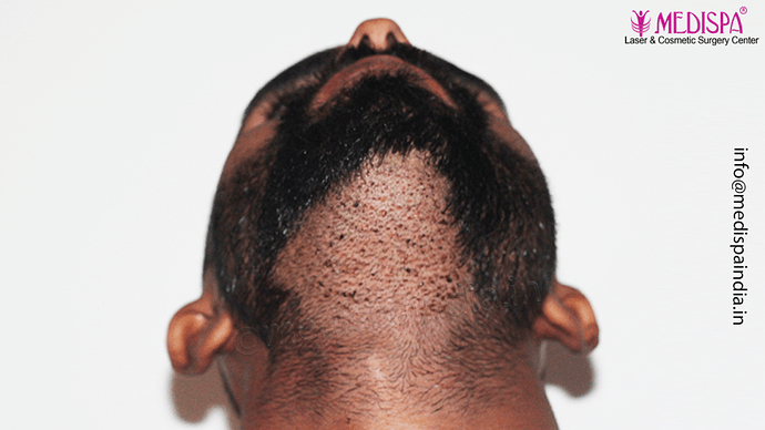 Dr. Suneet Soni - 5360 Grafts | 12-Month Result | Combination FUT + FUE + Beard photo