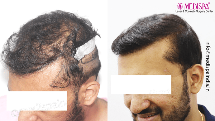 Dr. Suneet Soni - 4665 Grafts, Combine FUT + FUE + BHT (Beard) Technique photo