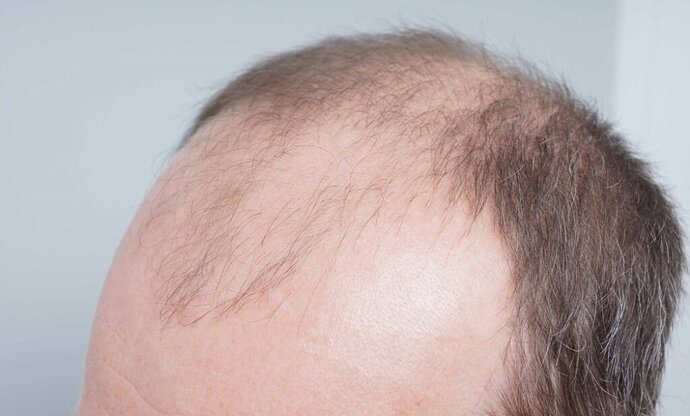 Dr B Farjo - FUE - 2091 Grafts photo