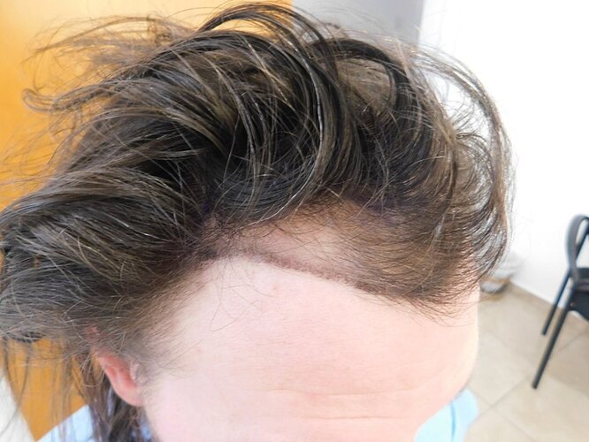 Hairline FUE Result for 2500 Grafts – 8 Months After – HDC Hair Clinic photo
