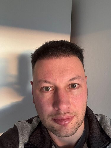 Ozlem Bicer MD-Hair Transplant-2910 Grafts FUE by micro-motor, 7. months result photo