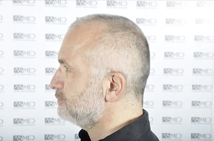 Asmed Clinic - FUE Hair Transplant - 5041 Grafts photo
