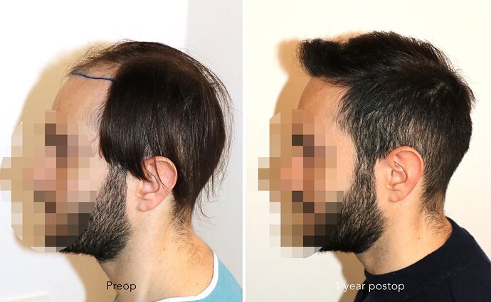 Case performed by Dr. Feriduni – 3744 FU in 1 procedure photo