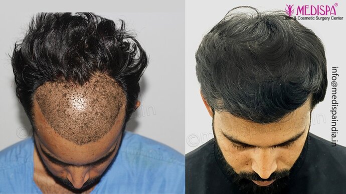 Dr. Suneet Soni - 3029 FUE Grafts, FUE Method (Trivellini System), NW - III photo