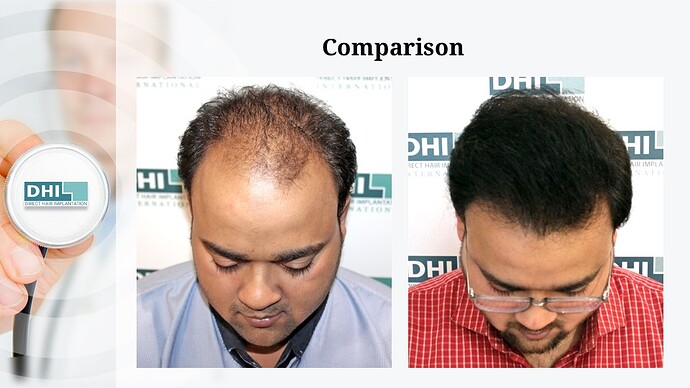 DHI India | NW Scale 5 | 2,923 Grafts | 9-Months DHI Hair Transplant Results photo