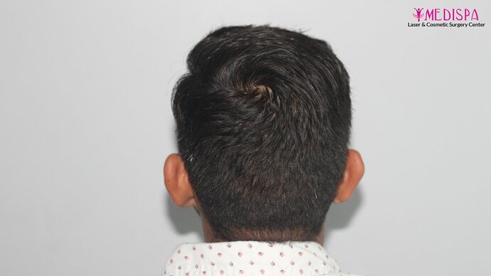 Dr. Suneet Soni - 4025 Grafts | 12-Month Result | Combination FUT + FUE photo