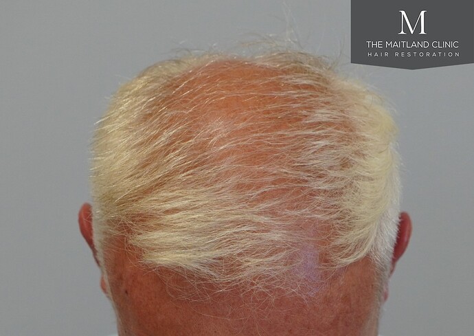 Dr Ball - The Maitland Clinic 2280 Grafts by FUE photo