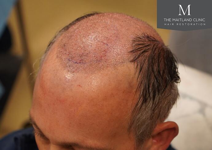 Dr Ball - The Maitland Clinic 2448 Grafts By FUT photo