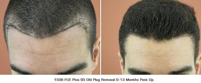 1508 FUE & 95 Plug Removal Repair 0-13 Months Hairline photo