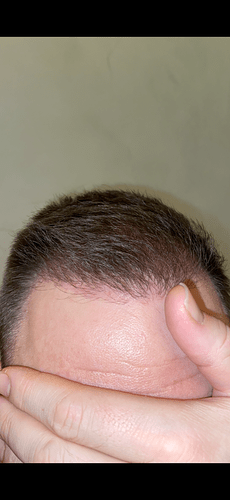 Dr.Bisanga, BHR Clinic Brussels 3251 FUE 0 - 8 Months photo