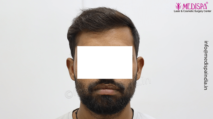 Dr. Suneet Soni - 5360 Grafts | 12-Month Result | Combination FUT + FUE + Beard photo