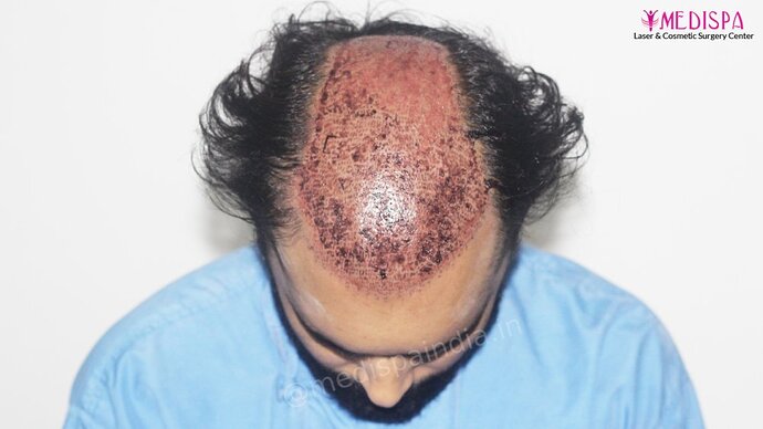 Revision Hair Transplant - 5111 Grafts / 5 Years Result - Dr. Suneet Soni, Medispa India photo