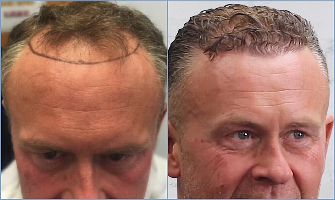 Dr. Nikos - hairline and frontal reconstruction 1500 FUE photo