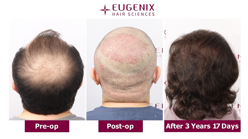 https://cdn.forumhairtransplant.com/optimized/3X/8/7/874a3bf4db3be08383fe240f805faa88546666c1_2_1035x582.jpeg