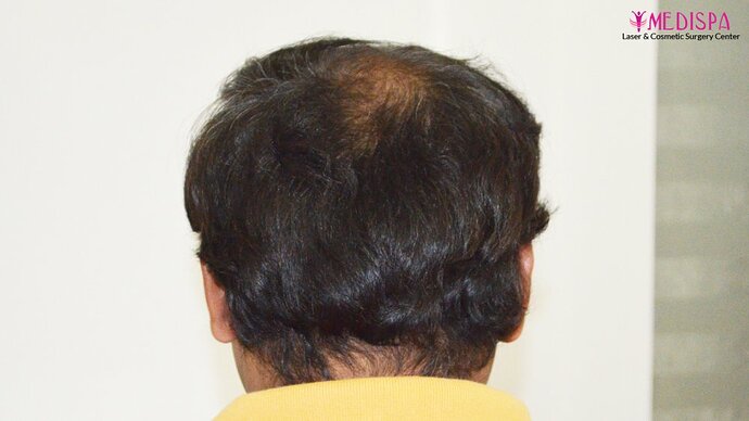 11600 Grafts in 3 FUT Sittings by Dr Suneet Soni photo