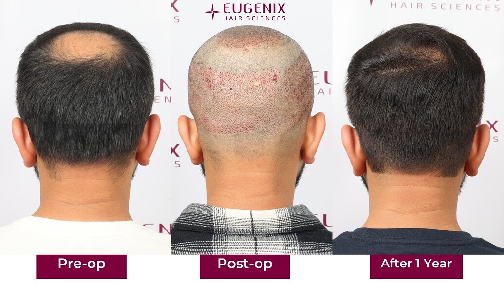 https://cdn.forumhairtransplant.com/optimized/3X/8/7/875c50a06a7e4ed409598196a6aa1ae4c736e208_2_1035x582.jpeg