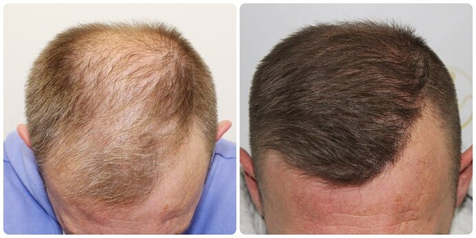 Dr Bonaros, Glasgow, UK / Receding Hairline Hair Transplant Result / 1814 FUE grafts / 0-12 Months photo