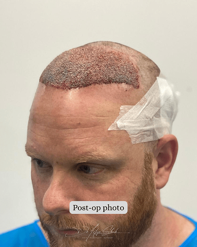 Dr Shah (London, UK) 3114 FUE grafts (0-12 months) photo