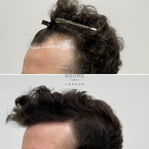 FUE Hairline Restoration 1306 Grafts- The Treatment Rooms London photo