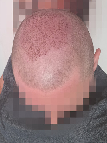 Dr Fares Seffen (Tunis, Tunisia) 2766 FUE results (Midscalps + Vertex) Day 0 --> 07 Months later photo