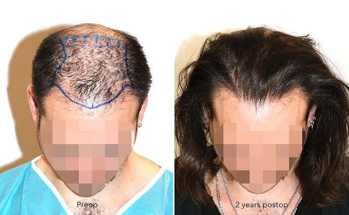Case performed by Dr. Feriduni – 3346 FU in 1 procedure photo
