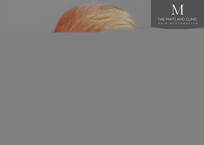 Dr Ball - The Maitland Clinic 2280 Grafts by FUE photo