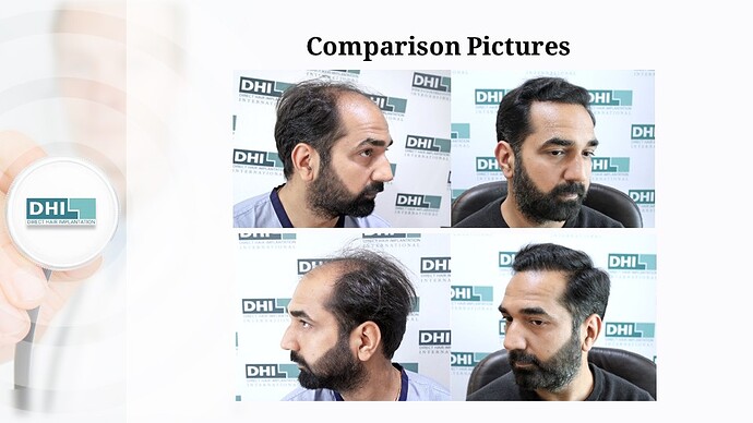 DHI India | NW 6 | 3,460 Grafts | 9-Months DHI Hair Transplant Results photo