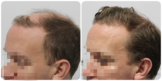 Dr Bonaros, Glasgow, UK / 4013 FUE grafts / 0-12 Months photo