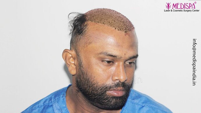 Dr. Suneet Soni - 5498 Grafts, 2 Years Result, Combine FUT + FUE + Beard Technique, NW-VI photo