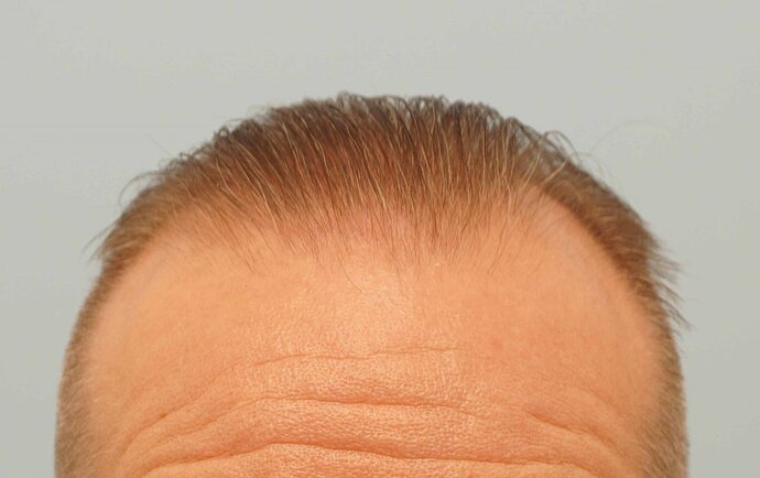 Dr B Farjo 1700g FUE (Front) photo