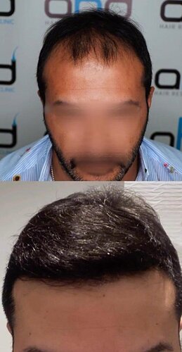 DR HAKAN DOGANAY/ 4500 GRAFTS / Implanter Pen+FUE photo