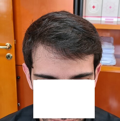 Result of 4000 grafts – 11 months after – NW class 4 photo
