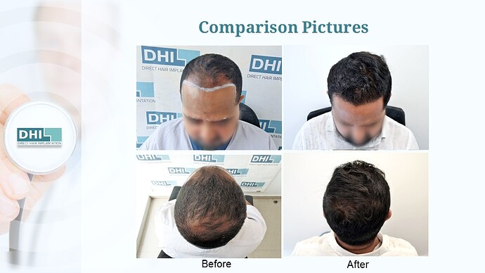 DHI India™ | NW 3 | 3,506 Grafts | 7 Months Hair Transplant photo