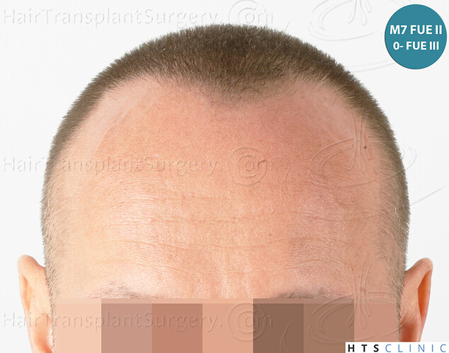 Dr. Jean Devroye, HTS Clinic / 5280 FUE (2008 + 2018 + 1254) / 3 sessions photo