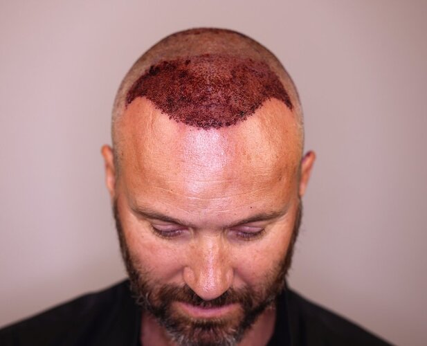 Utah Hair Restoration - Dr. Barton alviarmani photo