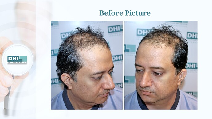 DHI India™ | NW 5 | 3,323 Grafts | 1 Year Hair Transplant Result photo