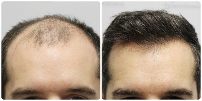 Dr Bonaros, Glasgow, UK / 4033 FUE grafts / 0-12 Months photo