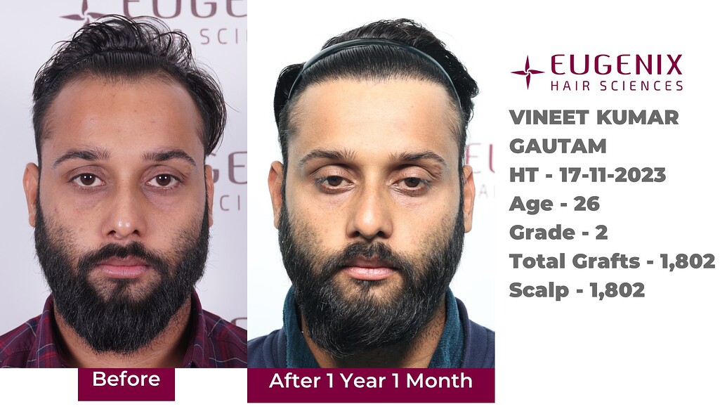 https://cdn.forumhairtransplant.com/optimized/3X/8/9/89f9adc6aeb1e77da871fc2931f46b0d7648c1d8_2_1035x582.jpeg