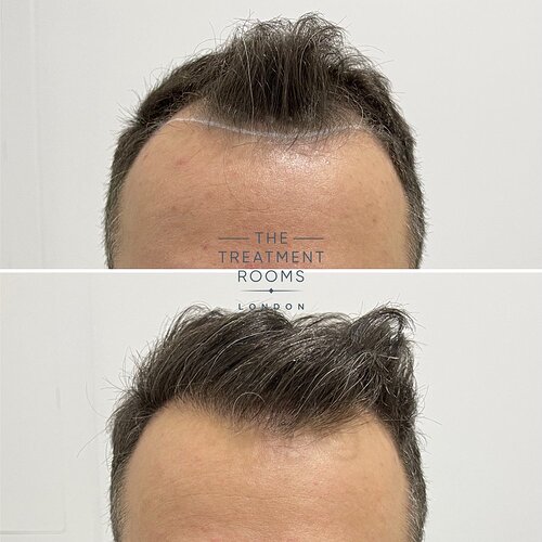 Hairline FUE hair transplant -1321 grafts photo