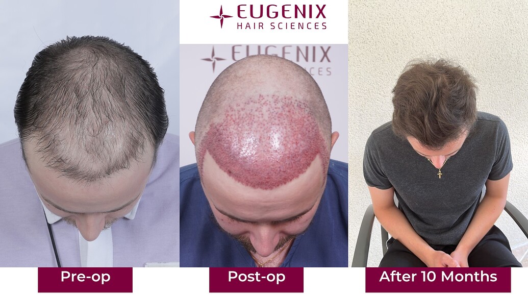 https://cdn.forumhairtransplant.com/optimized/3X/8/a/8a3a1897a171d552fb013e0917d25781df836279_2_1035x582.jpeg