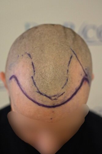Ozlem Bicer MD-2340 Grafts FUE by micro-motor, 12. month result  photo