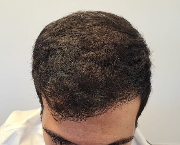 FUE Hair Transplant Result for 3100 Grafts - NW3 – 8 Months After – HDC Hair Clinic photo