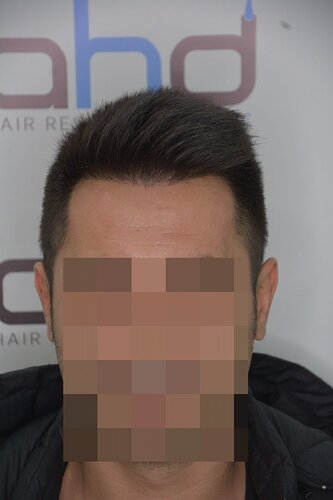 Hair Transplantation by Dr. Doganay / 1.400 grafts / Pen Implanter / 1 Year Result photo