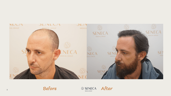 Seneca Medical Group - 3612 grafts with Direct Fue photo