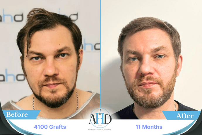 AHD Clinic Turkey - Hair Transplant Before & After Pictures - 4100 grafts - DHI photo