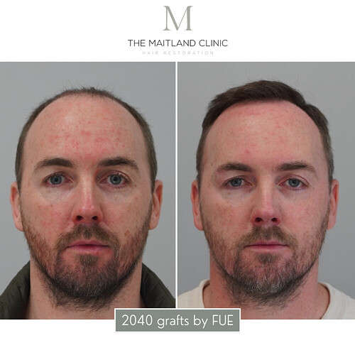 2468 grafts by FUE - Dr Ball, The Maitland Clinic photo
